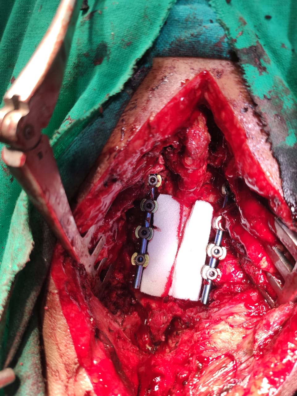 Operation of CERVICAL LATERAL MASS SCREW FIXATION C3 C4 C5 AND C6 and LAMINECTOMY C3,C4 AND C5
